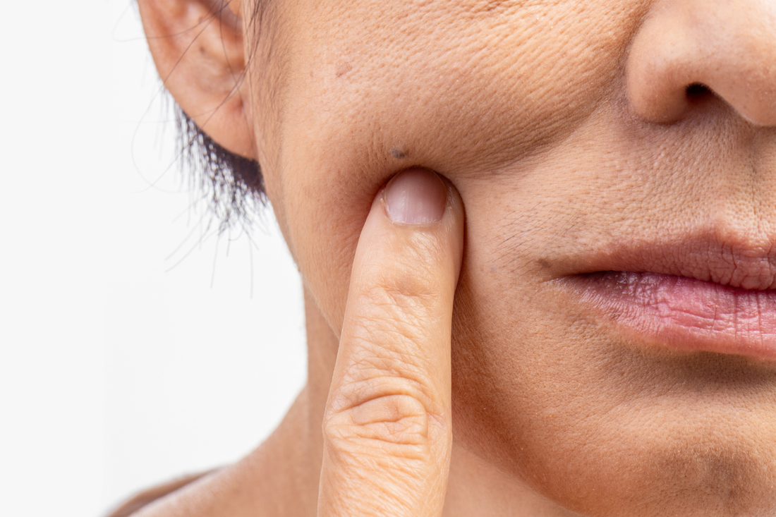 koza nakon ostavljanja cigara